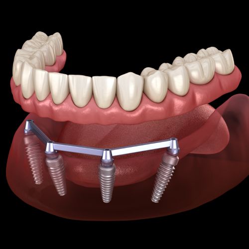 Are dental implants painful